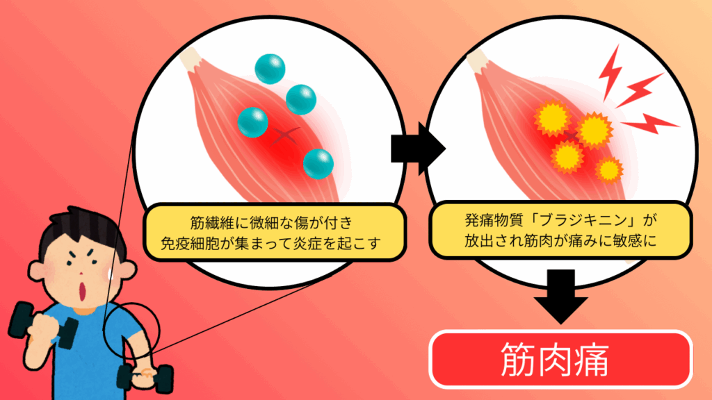筋肉痛の原因