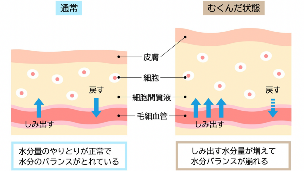 むくみのメカニズム